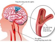 Đột quỵ: Nguyên nhân, dấu hiệu nhận biết, cách phòng tránh