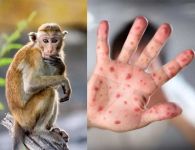 Bệnh đậu mùa khỉ có dấu hiệu gì?